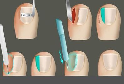 Отстранување на ноктот во присуство на габа на нозете