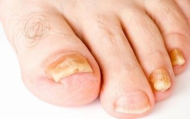 Фотографија симптоми на габа за нокти