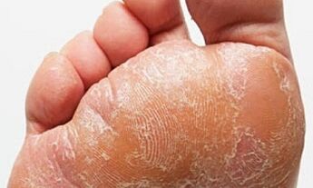 Знаци и симптоми на габа на нозете